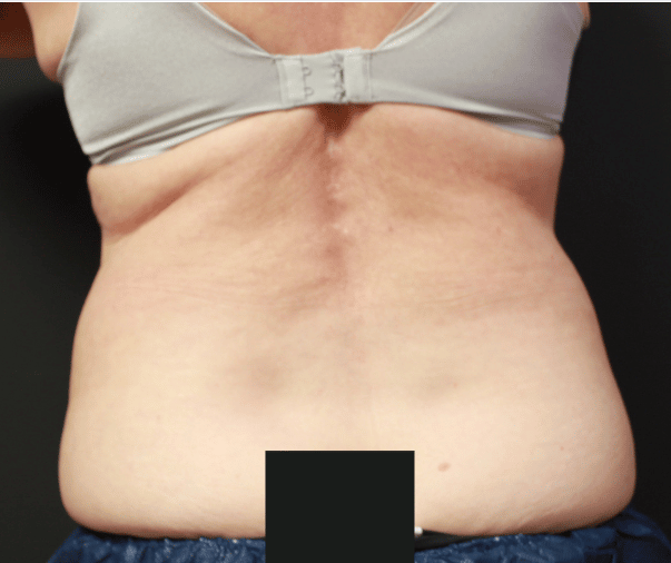 Before Image: CoolSculpting - front