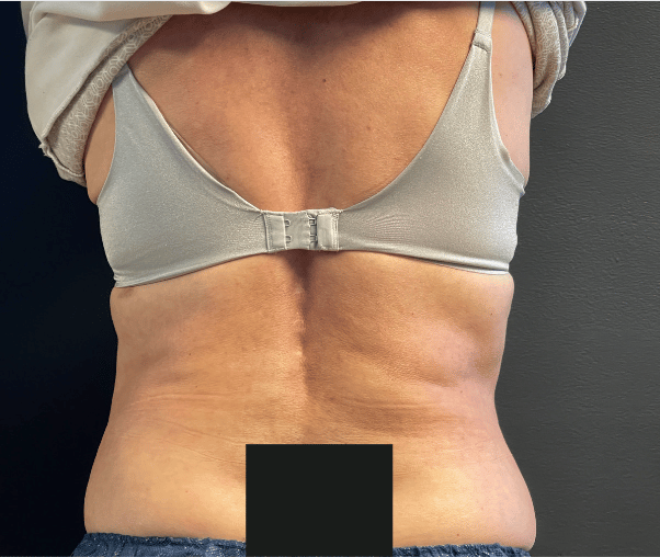 After Image: CoolSculpting - front
