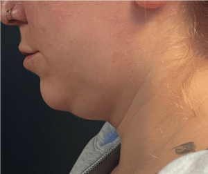 Before Image: CoolSculpting