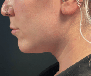 After Image: CoolSculpting