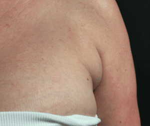 Before Image: CoolSculpting