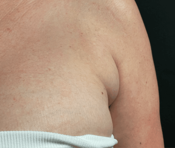 Before Image: CoolSculpting - front
