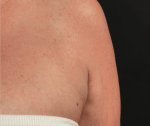 After Image: CoolSculpting