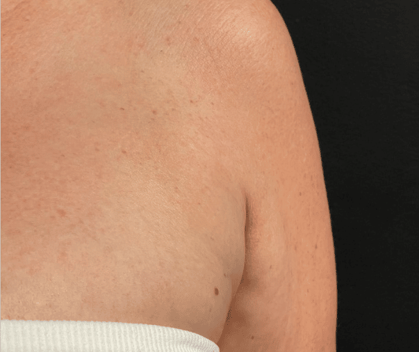 After Image: CoolSculpting - front