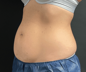 Before Image: CoolSculpting