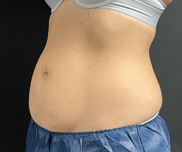 Before Image: CoolSculpting - left-front-oblique