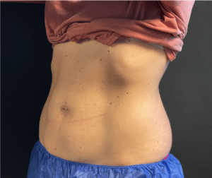 After Image: CoolSculpting