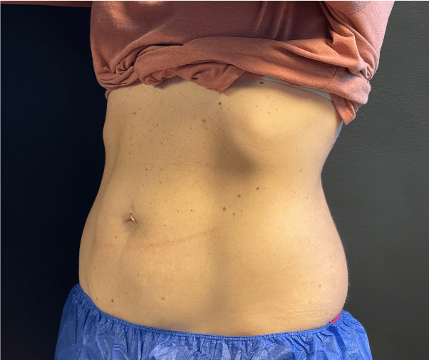 After Image: CoolSculpting - left-front-oblique