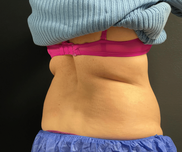 Before Image: CoolSculpting - left-back-oblique