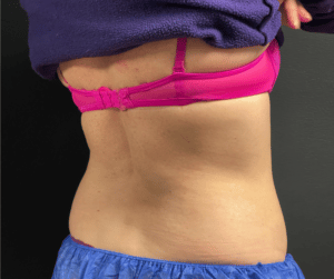 CoolSculpting