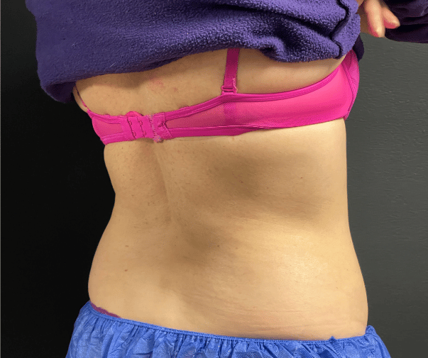 After Image: CoolSculpting - left-back-oblique