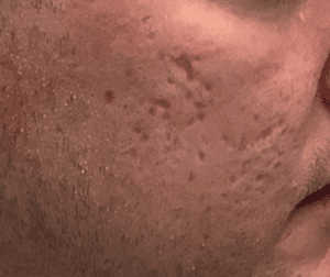 Microneedling – Acne Scars