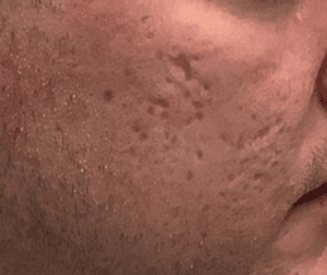 Before Image: Microneedling – Acne Scars