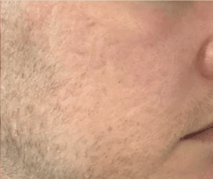 Microneedling – Acne Scars