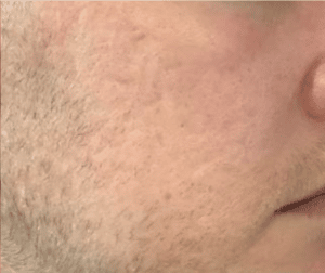 After Image: Microneedling – Acne Scars