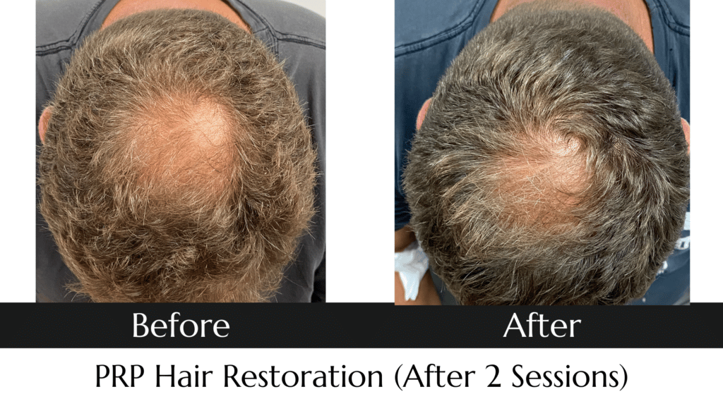 Before and after photo of PRP Hair Restoration Treatment at MedAesthetics in Sarnia.
