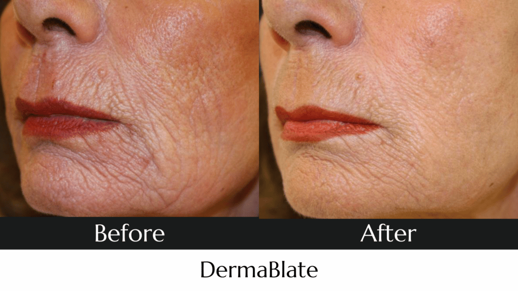 DermaBlate Before and After Photo MedAesthetics Sarnia
