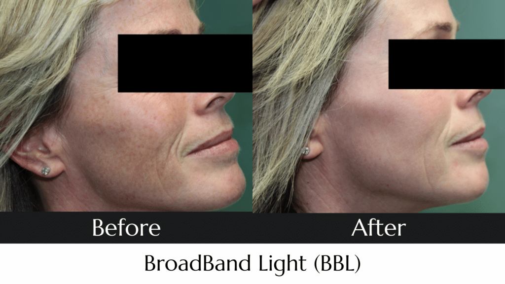 BroadBand Light (BBL) Before and After Photo MedAesthetics Sarnia