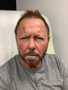 Before Image: BBL + Picoway + Botox