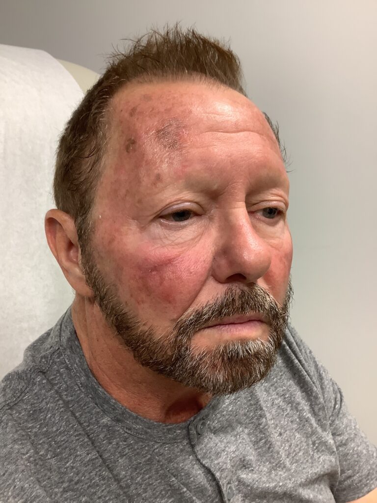 Before Image: BBL + Picoway + Botox - right-front-oblique