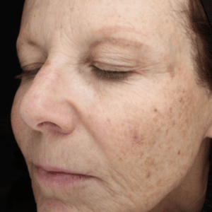 Before Image: BBL – Skin Pigmentation
