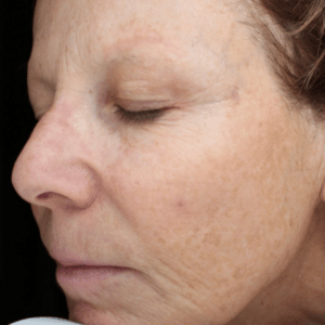 After Image: BBL – Skin Pigmentation