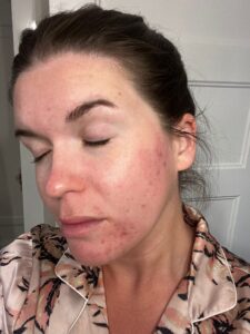 Before Image: E-Matrix & Skincare