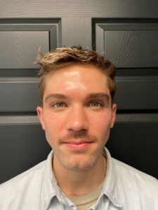 After Image: Juvederm Filler – Jawline