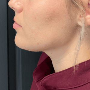 After Image: Juvederm Filler – Jawline