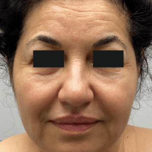 Before Image: Botox + Filler + Microneedling