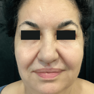 After Image: Botox + Filler + Microneedling