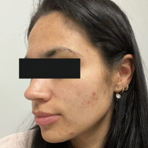After Image: Chemical Peel