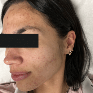 Before Image: Chemical Peel