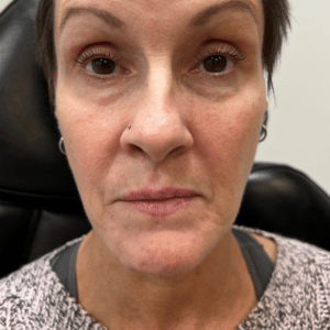 After Image: BBL + Yellow Laser – Blood Vessels