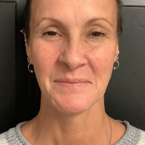 Before Image: BBL + Yellow Laser – Blood Vessels