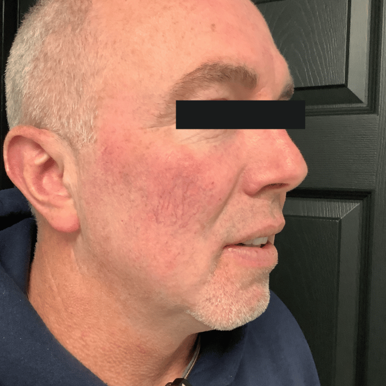 Before Image: BBL – Blood Vessels - front