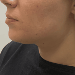 Before Image: Juvederm Filler – Jawline