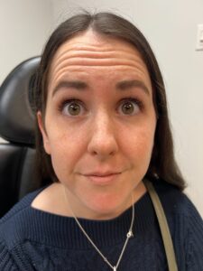 Botox – Forehead Wrinkles