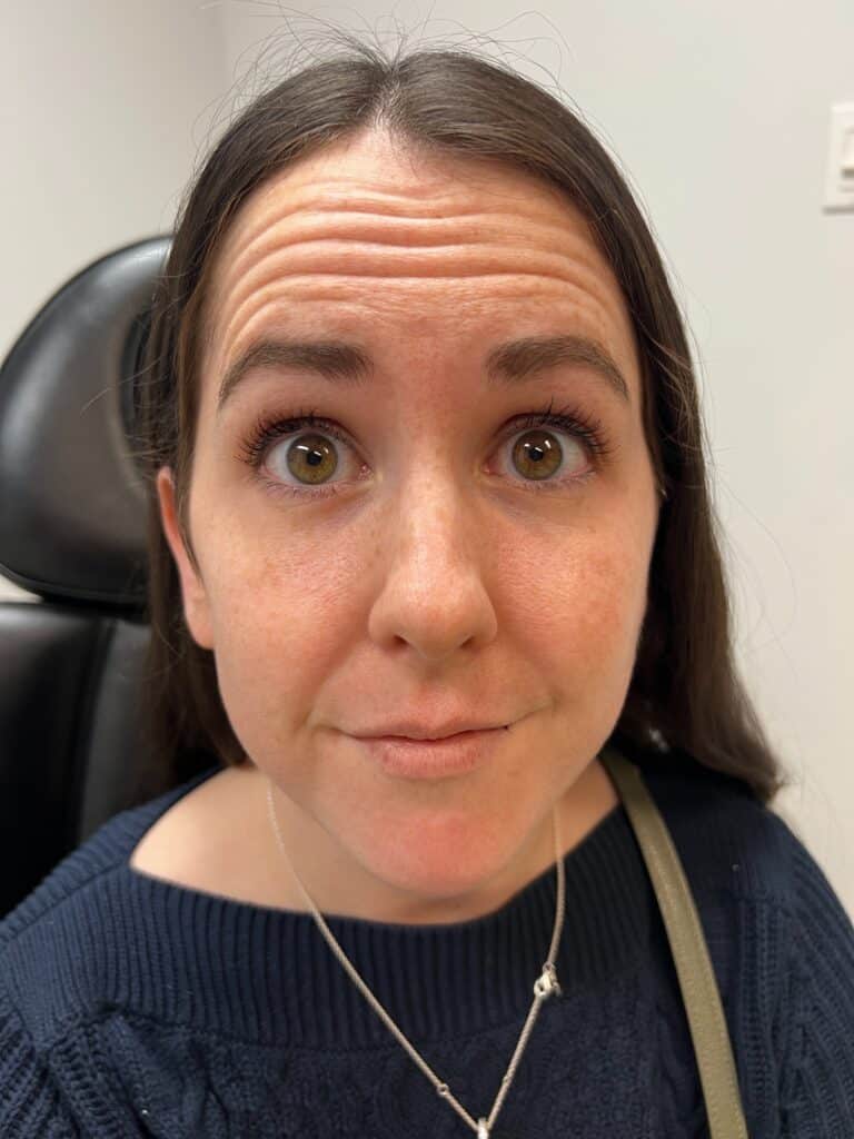 Before Image: Botox – Forehead Wrinkles - front