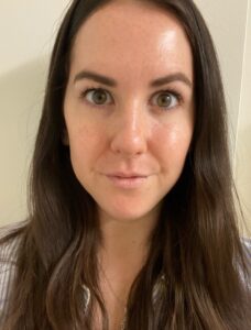 Botox – Forehead Wrinkles