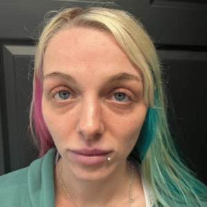 Cheek and Under Eye Filler