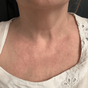BBL – Skin Pigmentation
