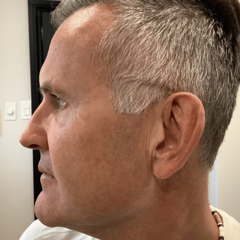 Before Image: Vampire Facial - left-side