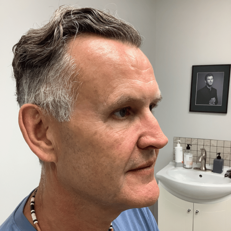 After Image: Vampire Facial - right-side