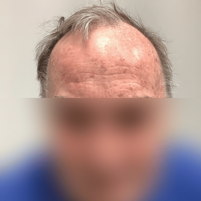 Before Image: Levulan Kerastick (Photodynamic Therapy) - front