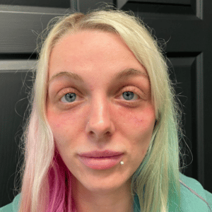 Cheek and Under Eye Filler