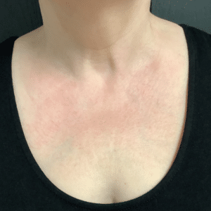 BBL – Skin Pigmentation