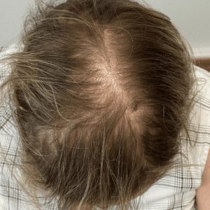 Before Image: PRP Hair Restoration – Female
