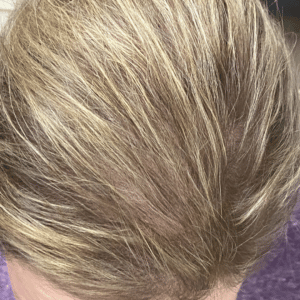 PRP Hair Restoration – Female