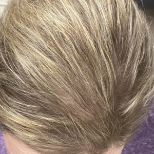 After Image: PRP Hair Restoration – Female